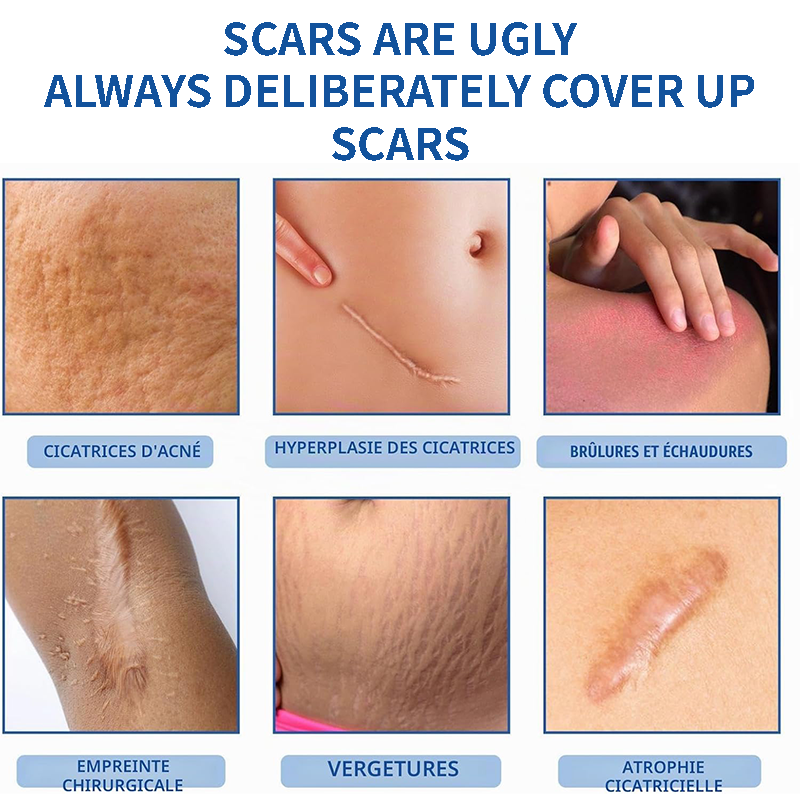 ScarSmooth™ – Great Care Cream for All Types of Skin Marks 🧴