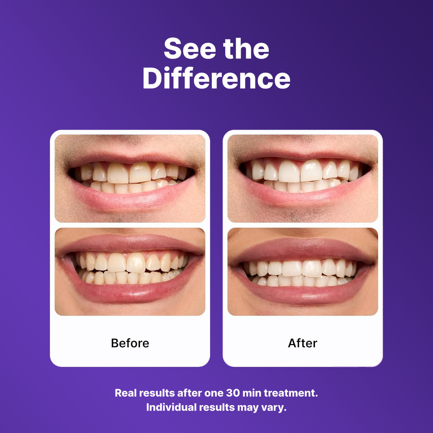 Purple Teeth Whitening Strips, Enamel-Safe Stain Removal💜