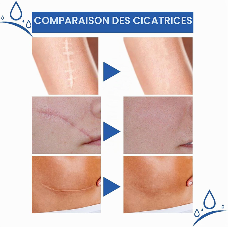 ScarSmooth™ – Great Care Cream for All Types of Skin Marks 🧴