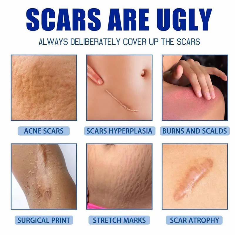 ScarSmooth™ – Great Care Cream for All Types of Skin Marks 🧴